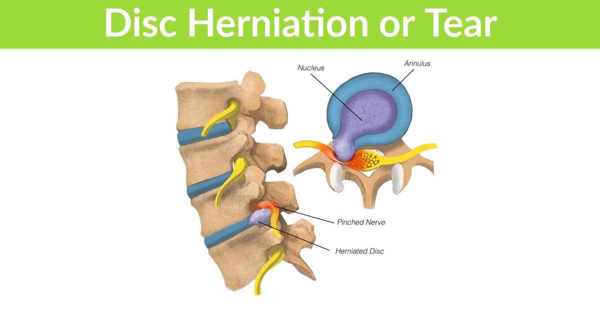 Disc Herniation or Tear