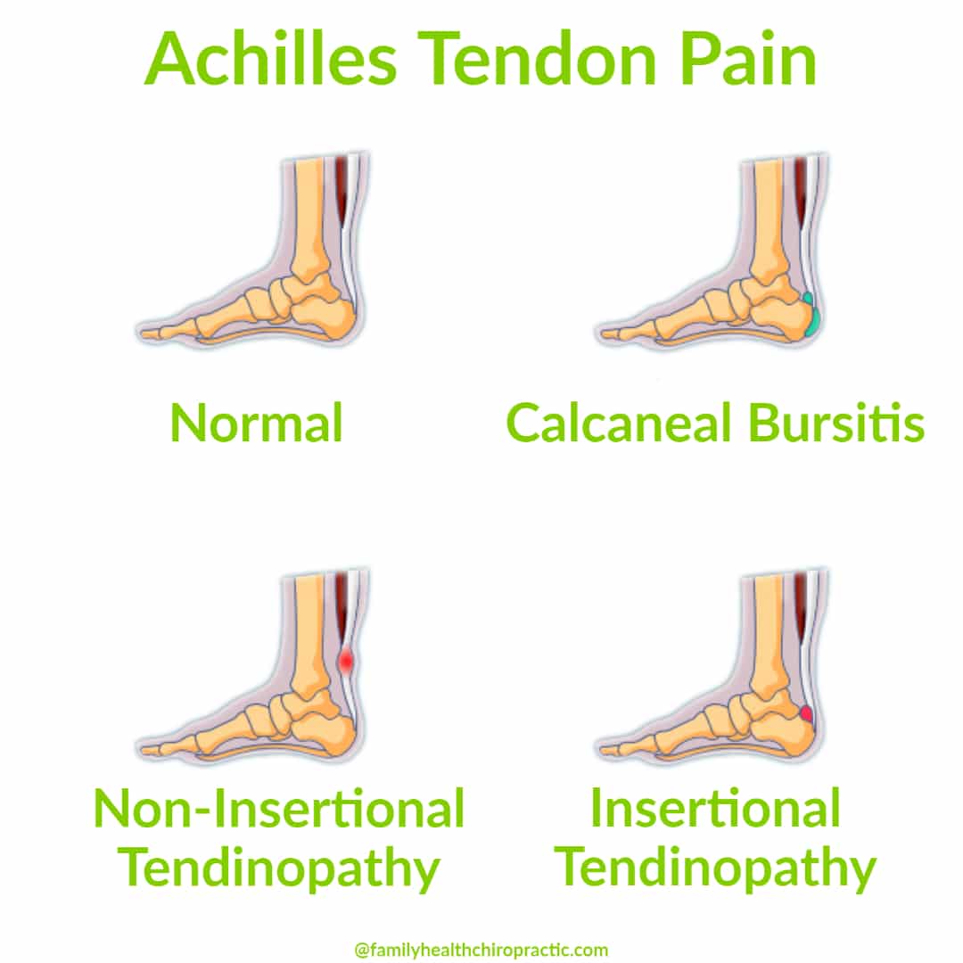 achilles tendon pain