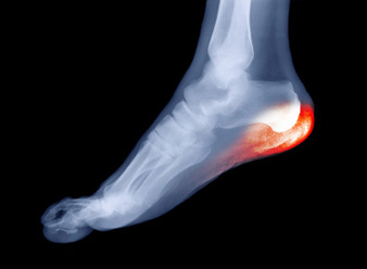 heel pain in austin texas