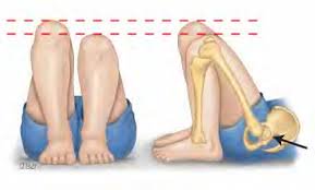 galeazzi test for uneven legs