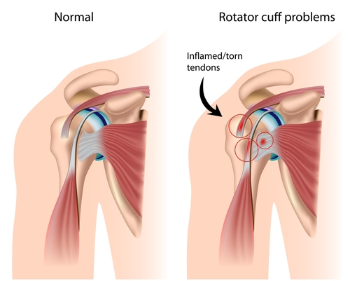 rotator cuff tears