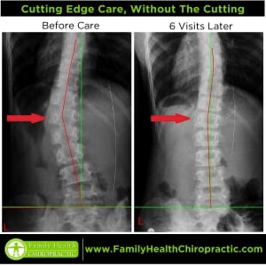 scoliosis treatment